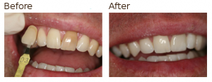 joe_before_and_after_dental_pics