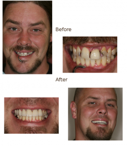 max_before_and_after