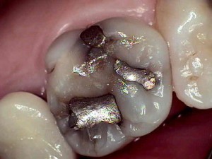 Cracked Mercury Filling Cracked Mercury Filling