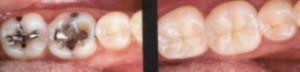Dental Onlays Before and After Dental Onlays Before and After