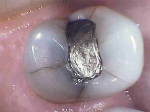 Mercury Free Restorations Mercury Free Restorations