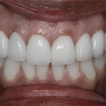veneers-after-a
