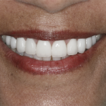 veneers-after-b