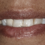 veneers-before